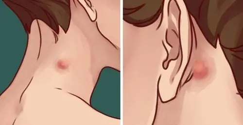   Swollen lymph nodes are divided into two types: benign and malignant lymph nodes.  