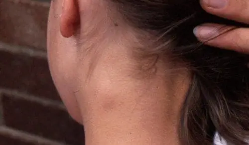   Swollen neck lymph nodes are a very common symptom and often occur when we have diseases related to the throat area.  