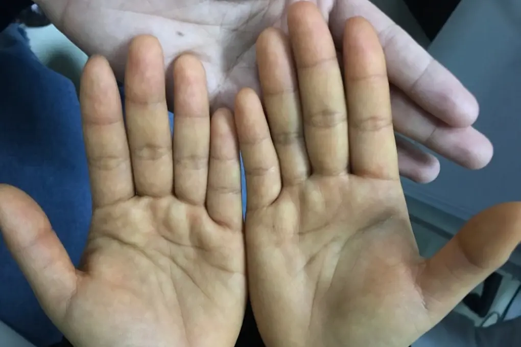 Trước khi ung thư đến, tay ch&acirc;n thường c&oacute; 4 dấu hiệu n&agrave;y - 3