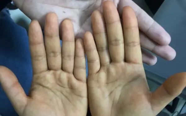 Before cancer arrives, hands and feet often have these 4 signs