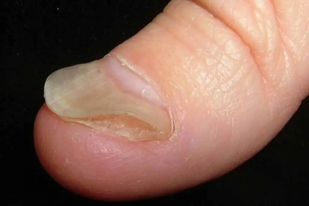 Trước khi ung thư đến, tay ch&acirc;n thường c&oacute; 4 dấu hiệu n&agrave;y - 2