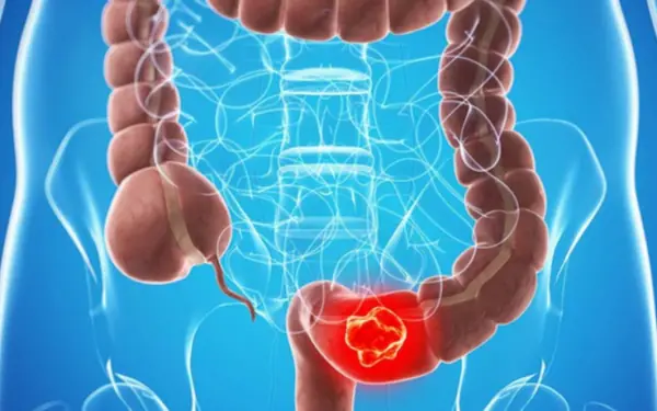 These factors can be the cause of c.o.l.on c.a.n.c.er