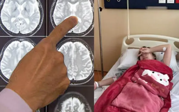 19 years old had a stroke