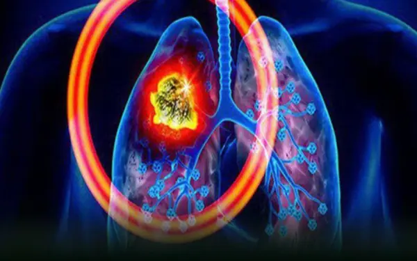 Prevent lung c.a.n.c.e.r early by  maintaining the following 5 habits every day