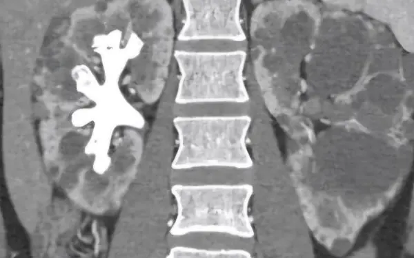 What Are Staghorn Kidney Stones?