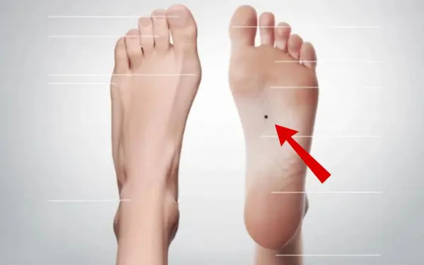 Moles on the Soles of the Feet: A Sign of Luck and Wealth?
