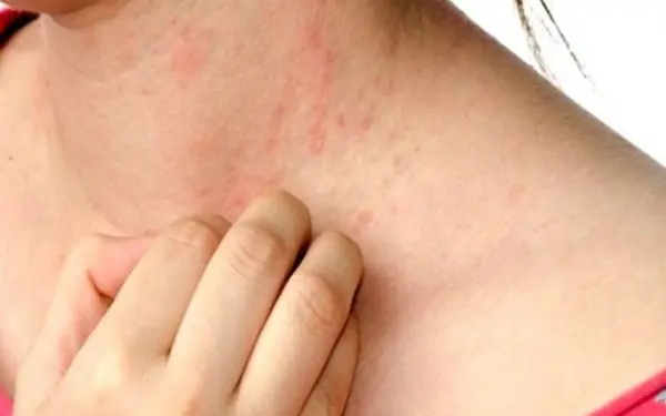 Itchy Skin in Cold Weather: What to Do for Quick Relief?