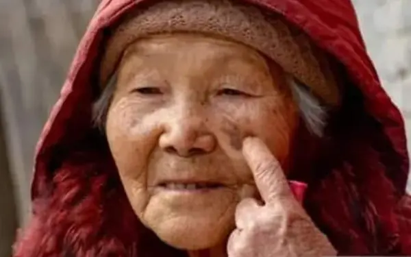 Age spots in the elderly