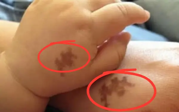 Birthmarks - Clues to another life?