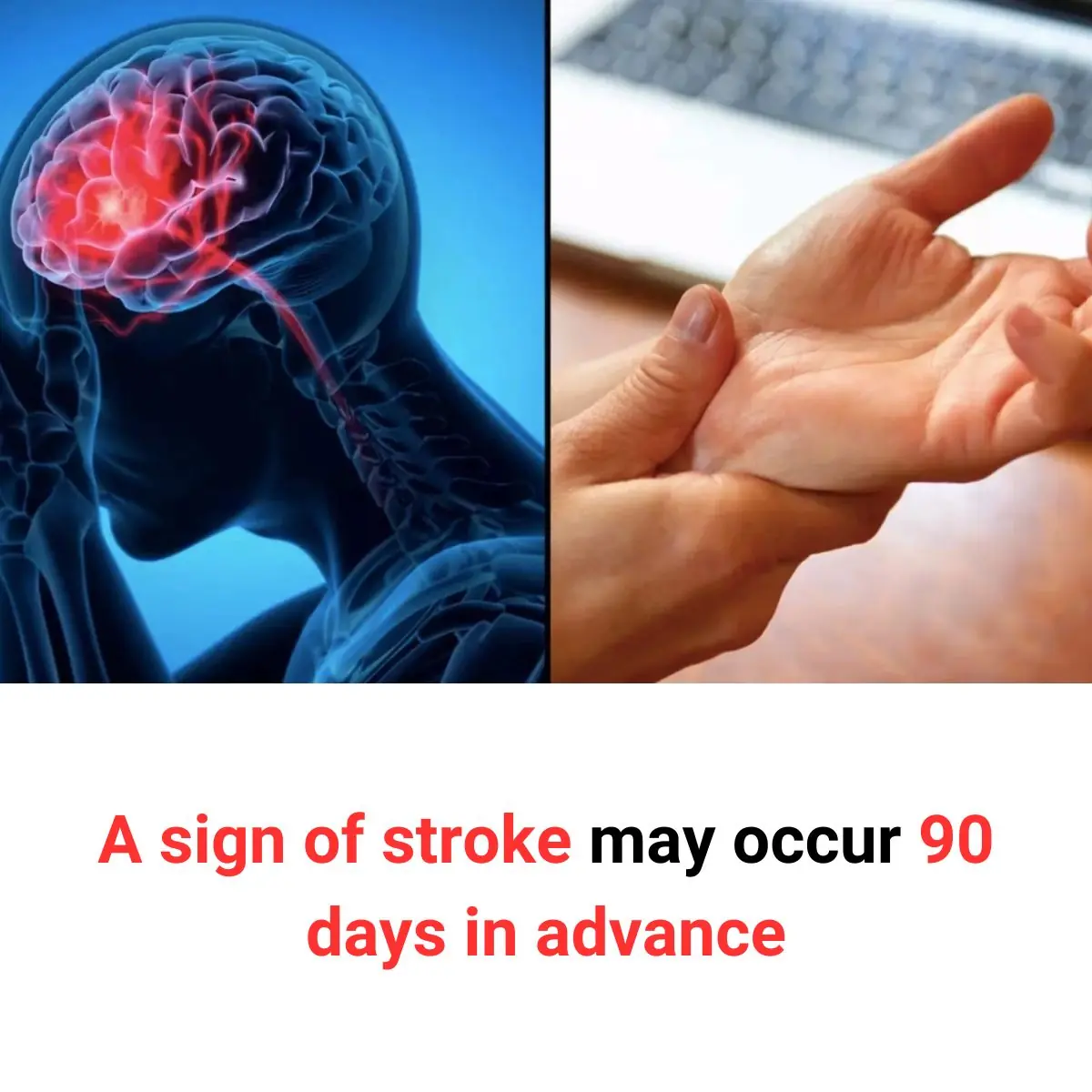 A Sign of Stroke May Occur 90 Days in Advance