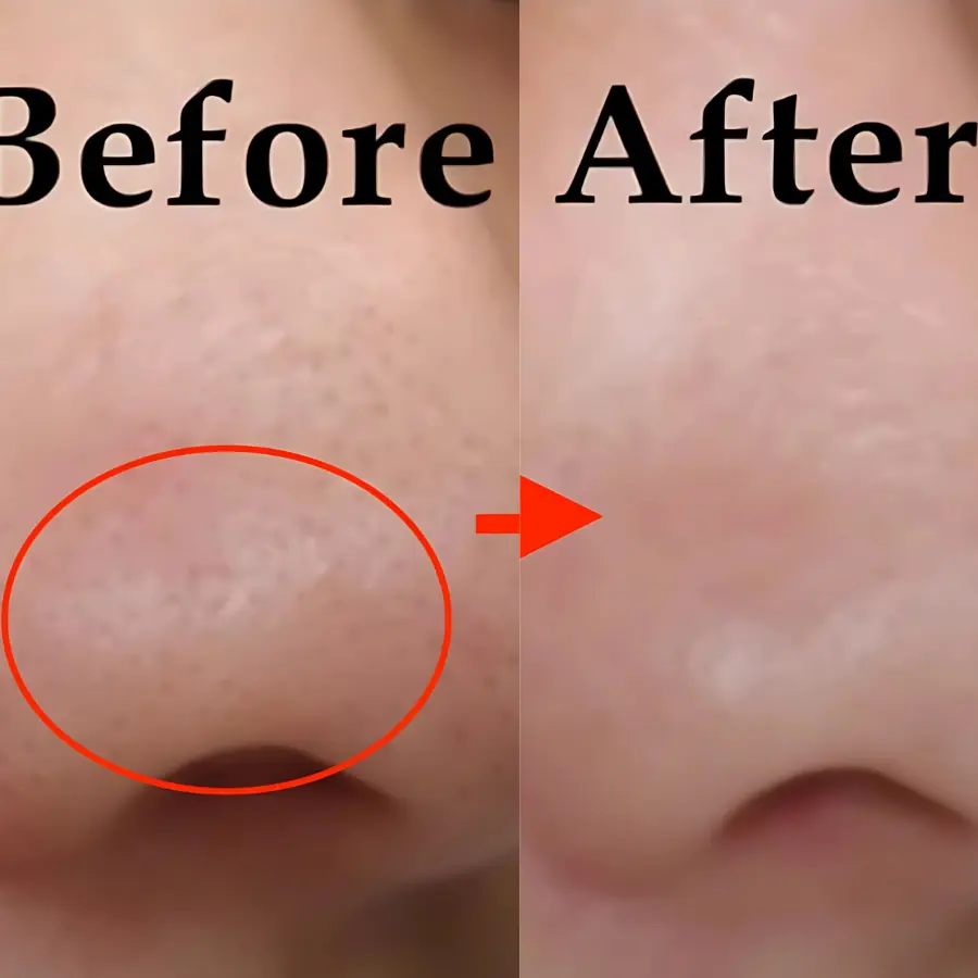 How to treat blackheads at home is both safe and effective