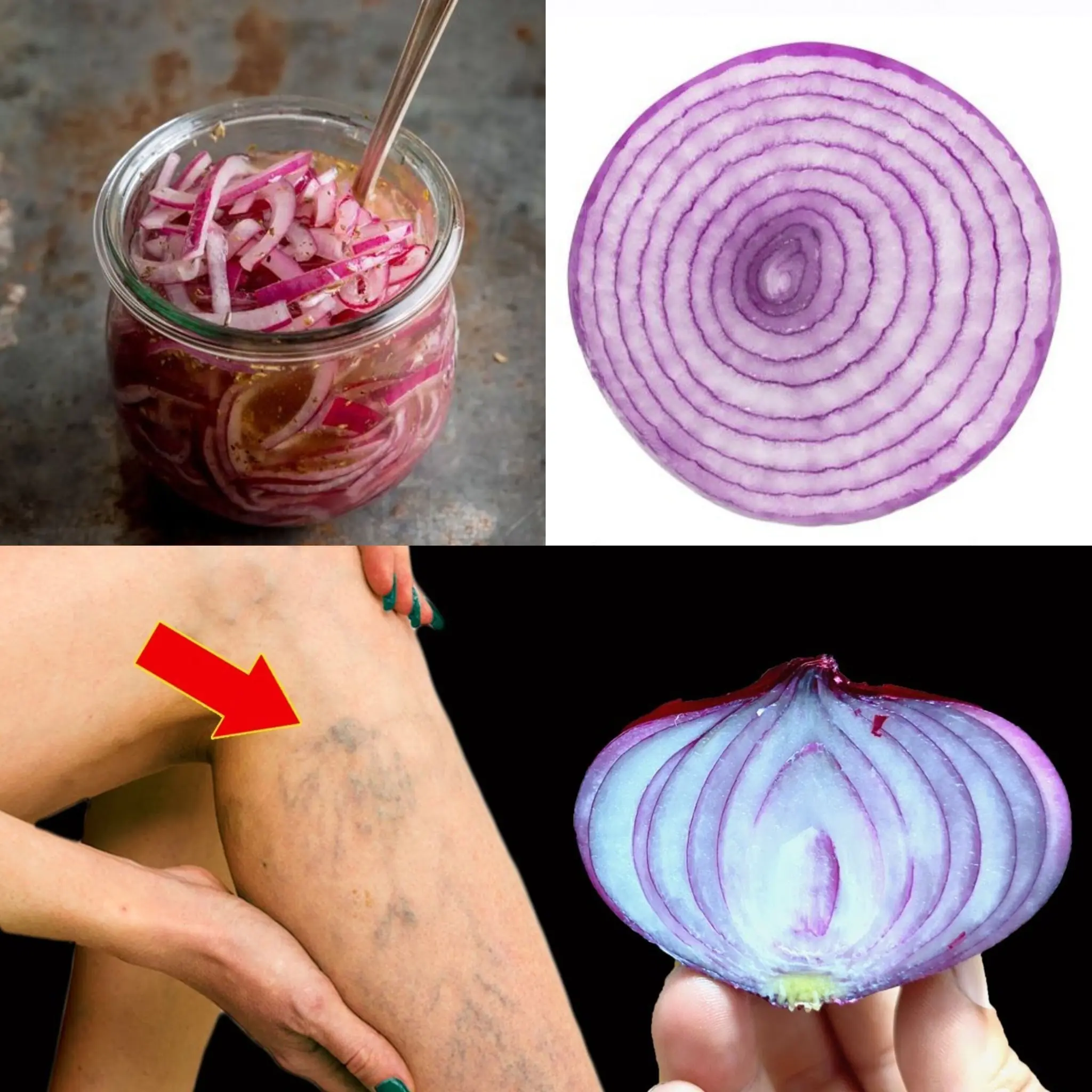 Transform Your Legs Naturally with Red Onion: The Varicose Vein Miracle!