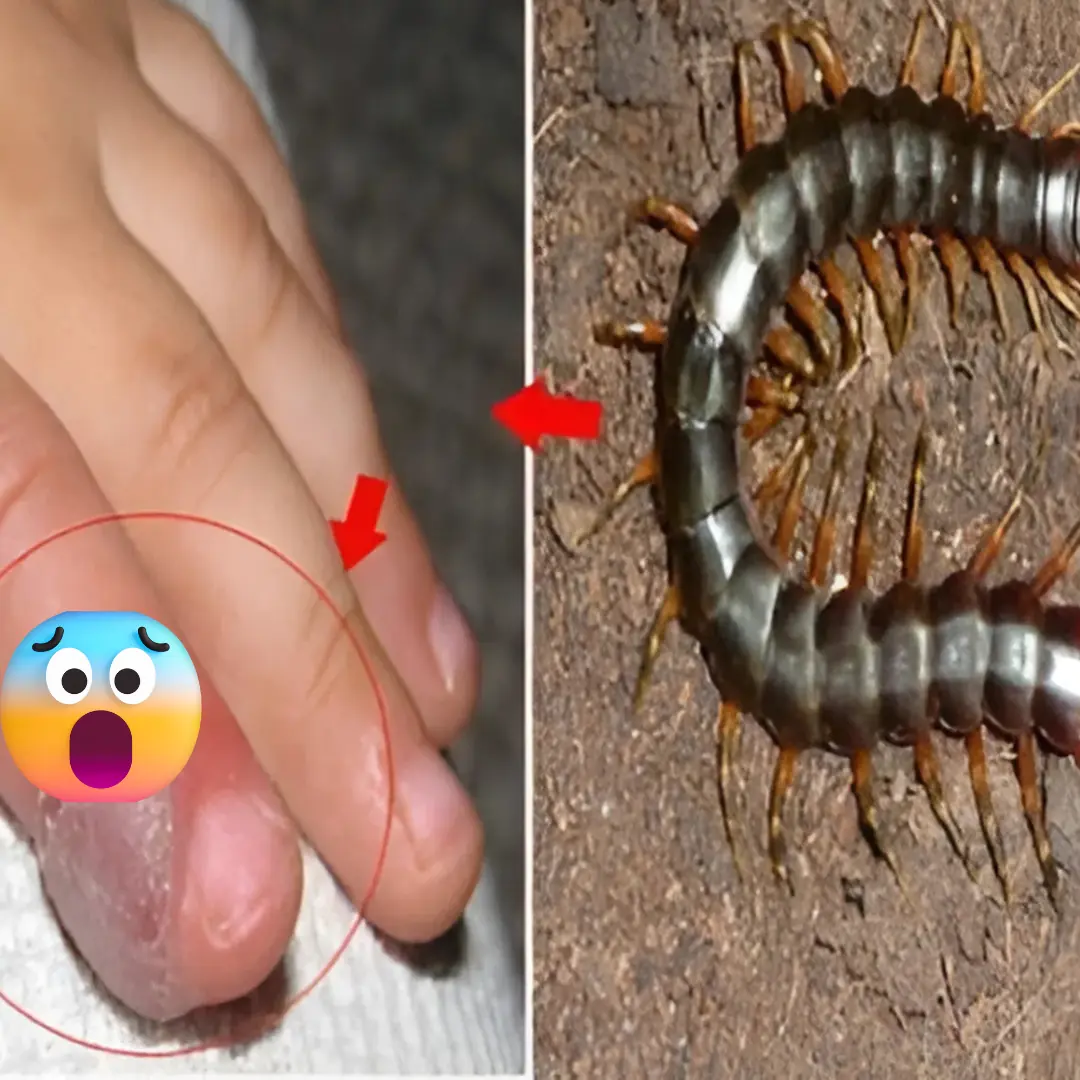 So how should you treat a centipede bite?