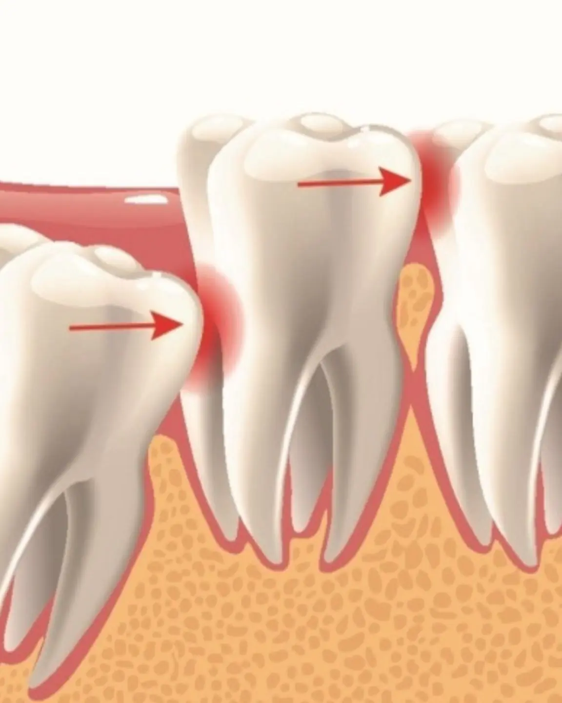 Impacted or crooked wisdom teeth - not only cause pain and discomfort but can also cause many dangerous complications