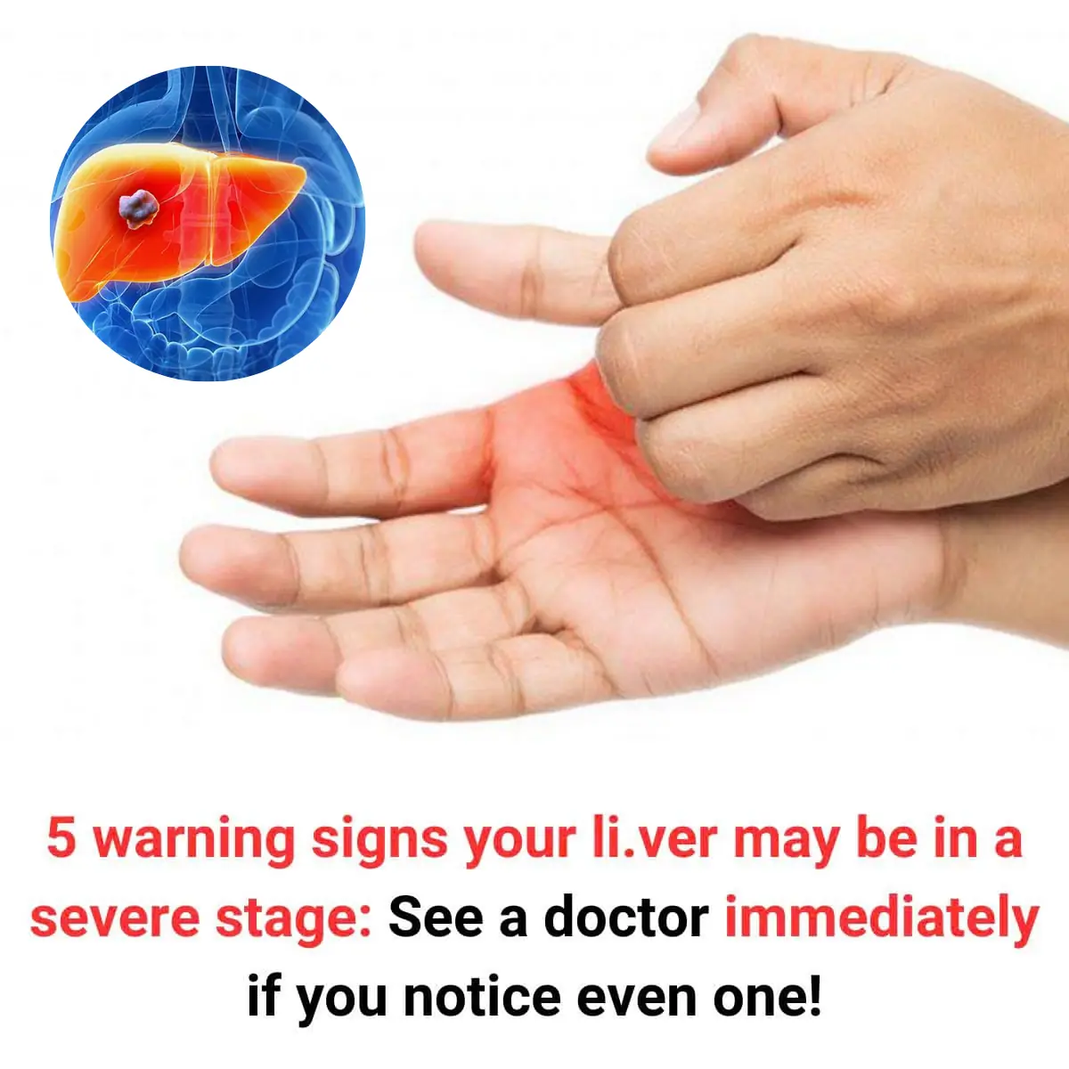 5 Warning Signs Your Liver May Be in a Severe Stage