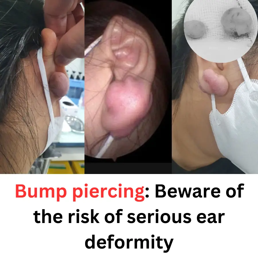 Bump piercing: Beware of the risk of serious ear deformity