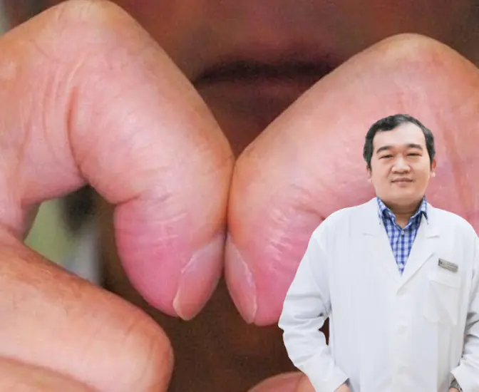 A Simple Finger Test Could Help Detect Lung Cancer Early