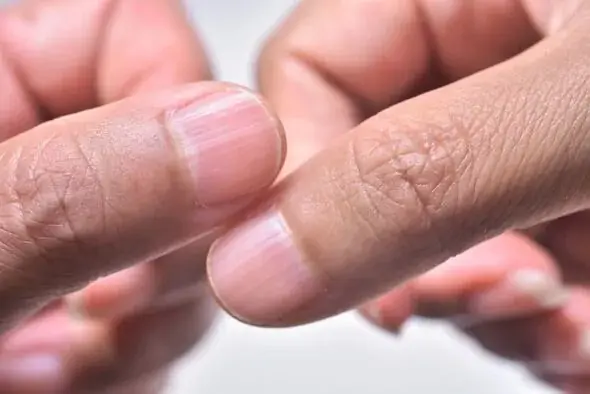 Observe Your Nails to Detect Health Issues