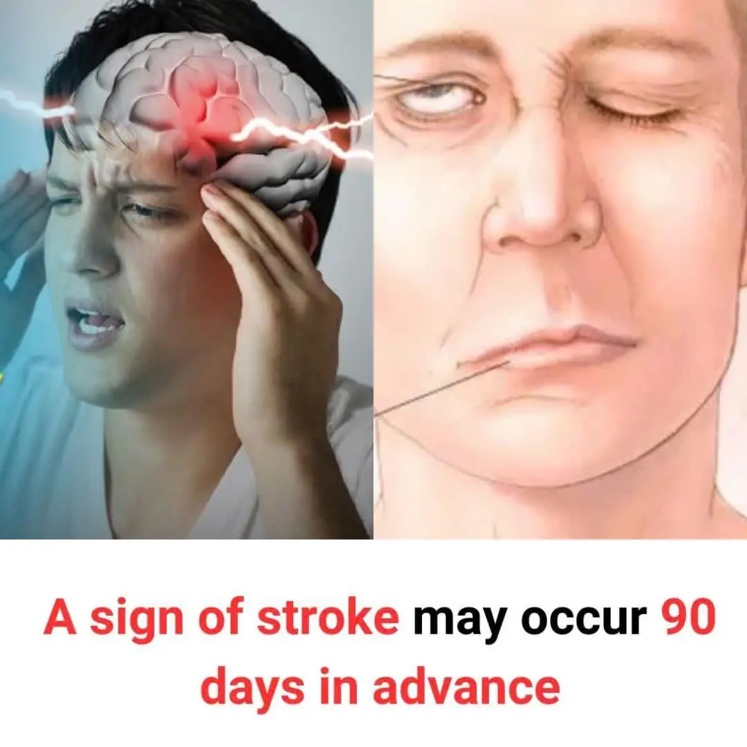 A Sign of Stroke May Occur 90 Days in Advance