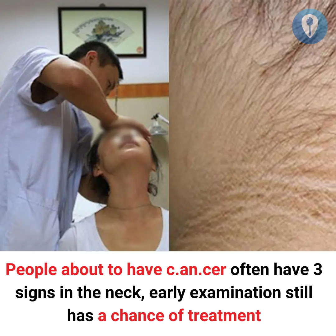 People about to have cancer often have 3 signs in the neck