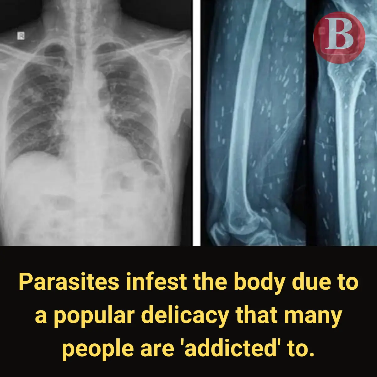 Parasites Infest the Body Due to a Popular Delicacy That Many People Are 'Addicted' To