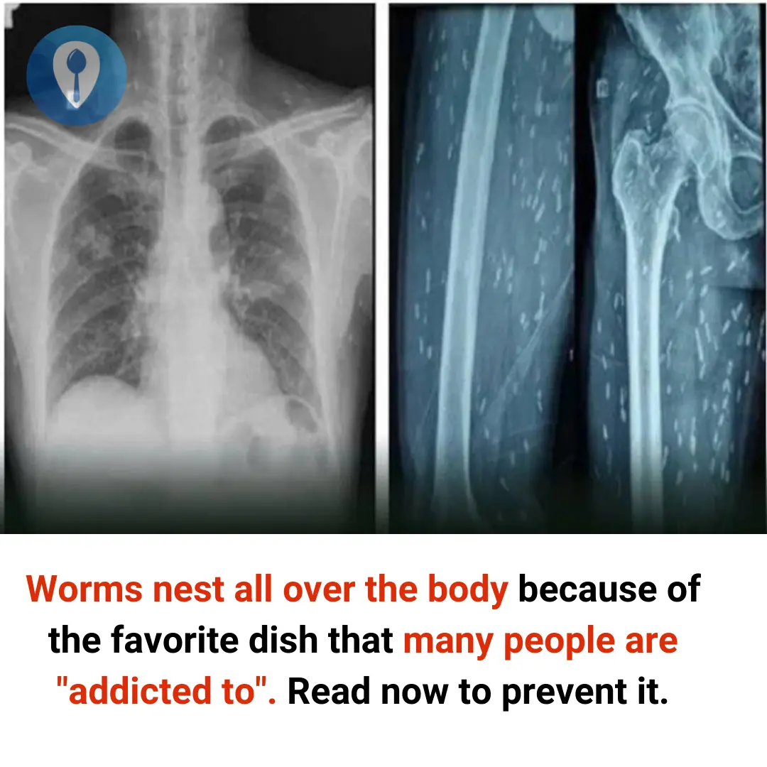 Worms nest all over the body because of the favorite dish