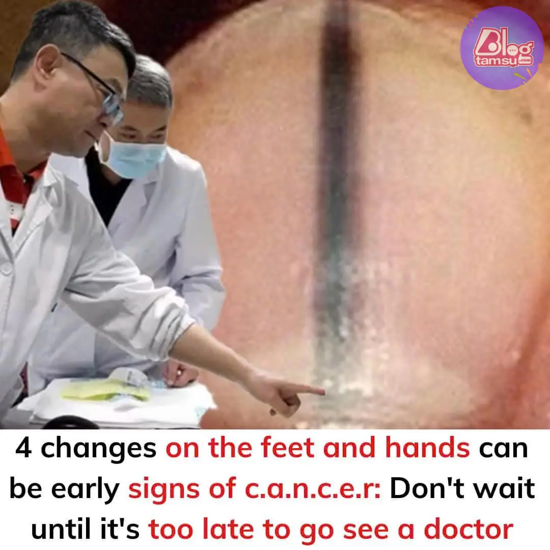 4 changes on the feet and hands can be early signs of c.a.n.c.e.r