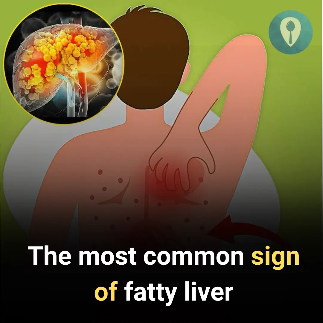 Fatty Liver: Causes, Symptoms, Treatment & Home Remedies