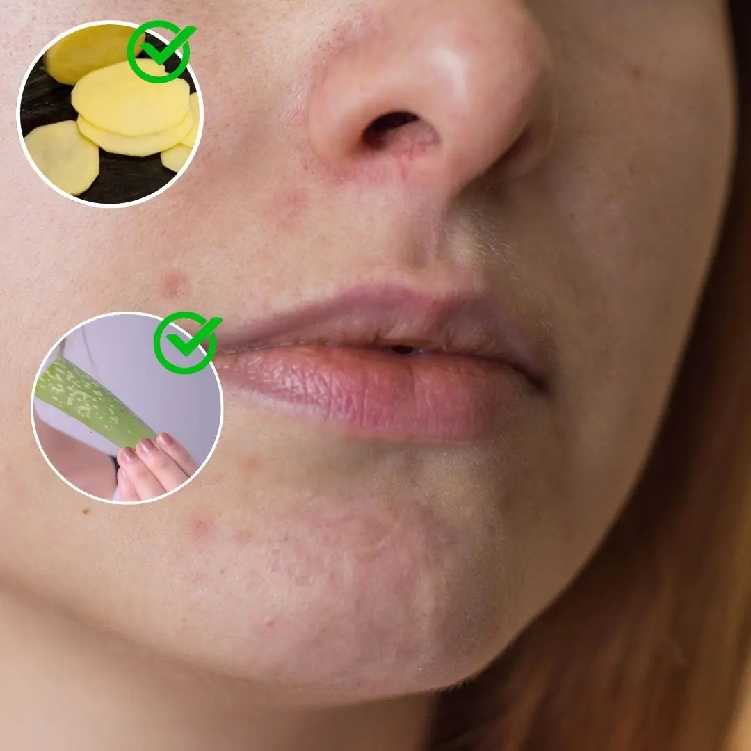 Remove brown spots on mouth with aloe vera and potatoes