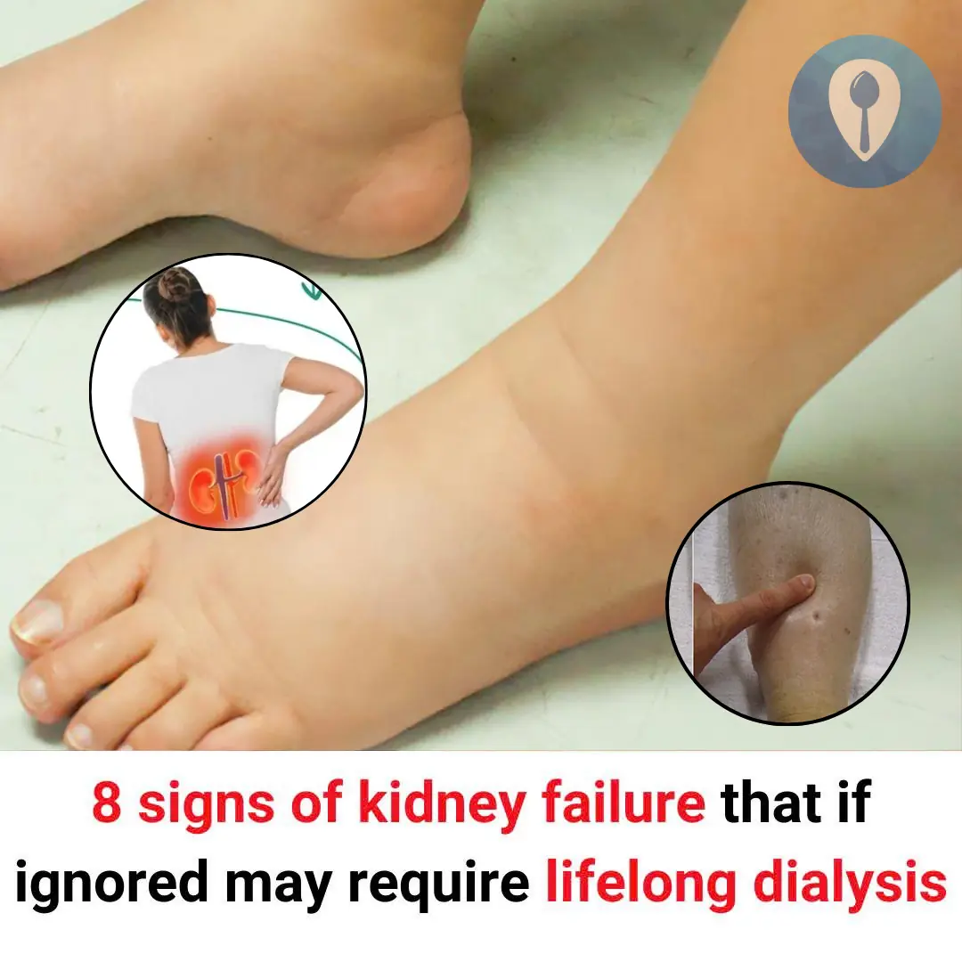 8 signs of kidney failure that if ignored may require lifelong dialysis