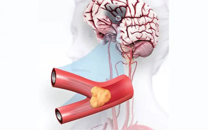 Effective Ways to Reduce the Risk of Cerebral Ischemia and Protect Brain Health