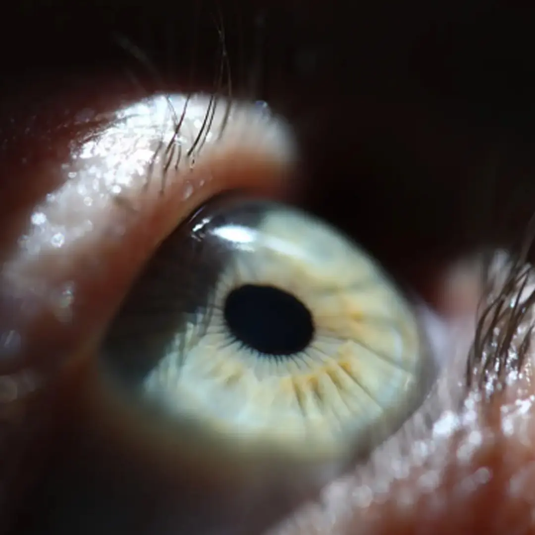 Implanting a tooth containing a lens into the eye helps a 33-year-old patient regain his vision