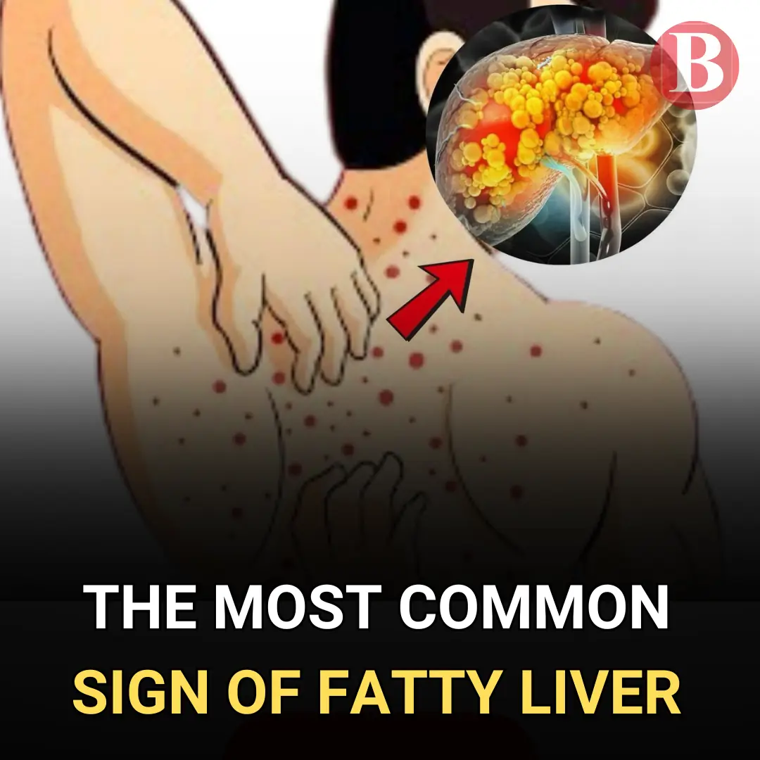 Fatty Liver: Causes, Symptoms, Treatment & Home Remedies