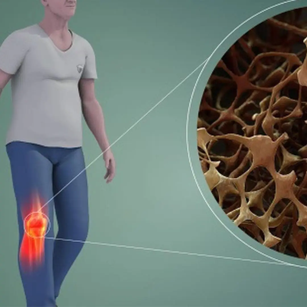 Should people with osteoporosis walk?