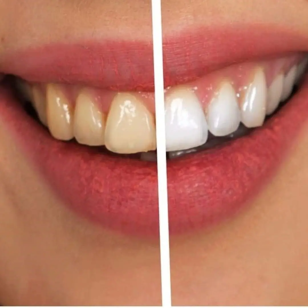 Many people still think that white teeth are healthy teeth