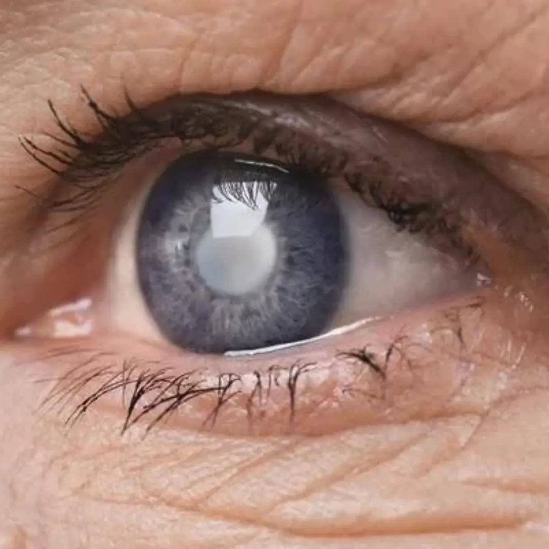 Unusual signs warning of cataracts that you should not ignore