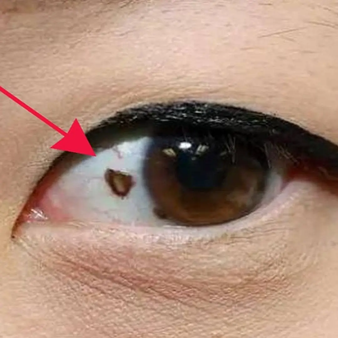 Mole in the eye - risk of developing eye c.a.ncer