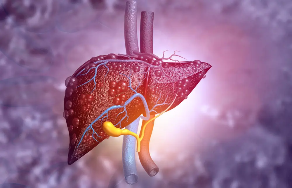 Fatty Liver: Causes, Symptoms, Treatment & Home Remedies