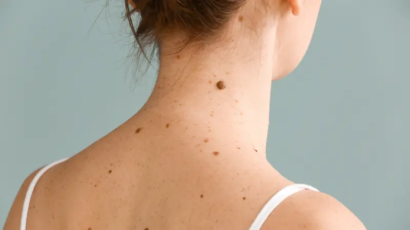 If a Mole Has These 5 Characteristics, Get a Can.cer Screening Immediately