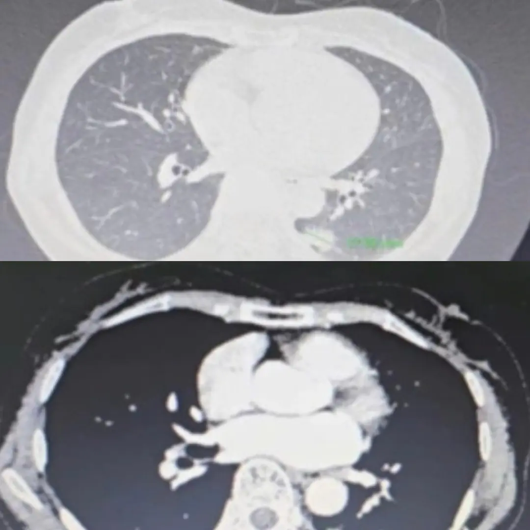 66-year-old w.o.man had inter.mittent ab.dominal p.a.in, suddenly los.t 3 kg, went to the doctor and discovered she had 2 ca.n.ce.rs