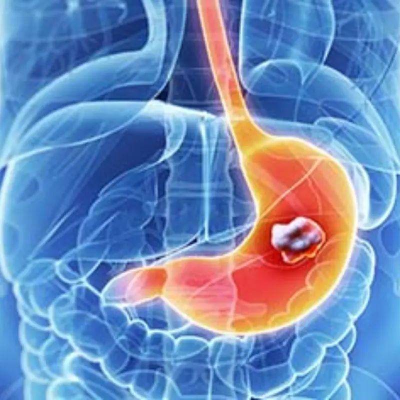 6 Early Signs of Stomach Cancer to Watch Out For