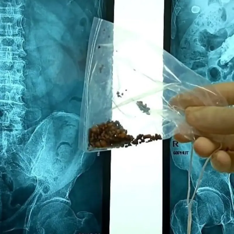 Gallstones are a common disease, affecting 8-10% of the population. Here are the symptoms and treatments