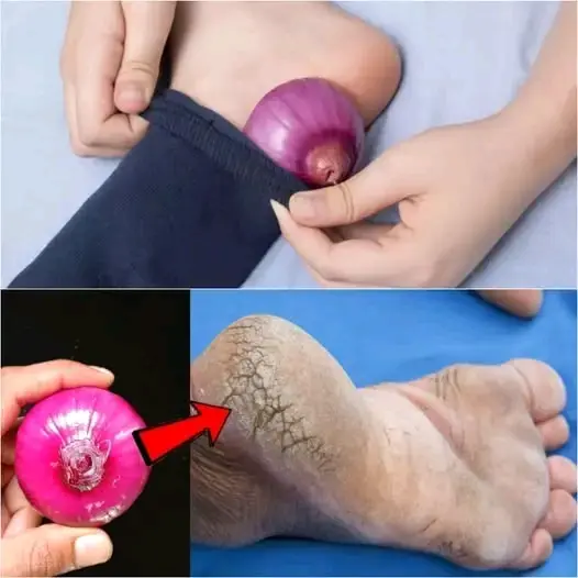 Remove Cracked Heels and Get Beautiful Feet Permanently