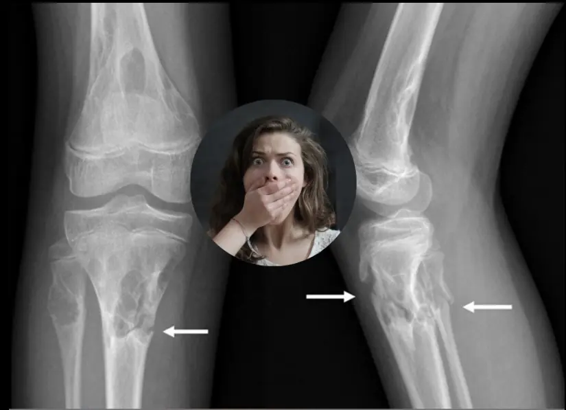 New hydrogel ịnection literally strengthens bones - increasing density by 5x