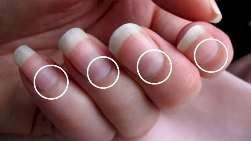 Don’t Wait Until You’re Hospitalized to Regret It: Your Fingernails Have Been Warning You of a Serious Illness for Months!