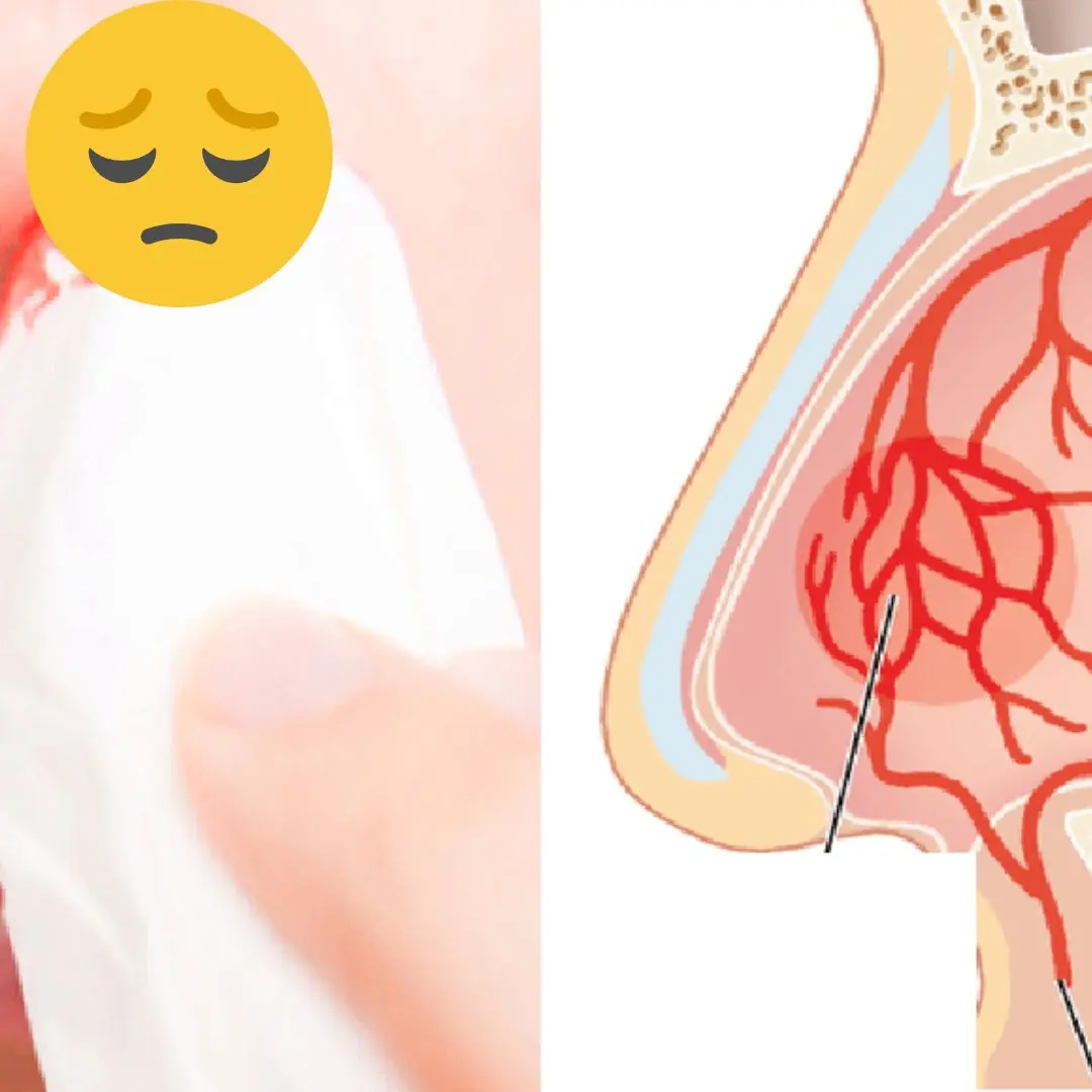 What are the symptoms of no.seble.eds and when should you see a doctor?