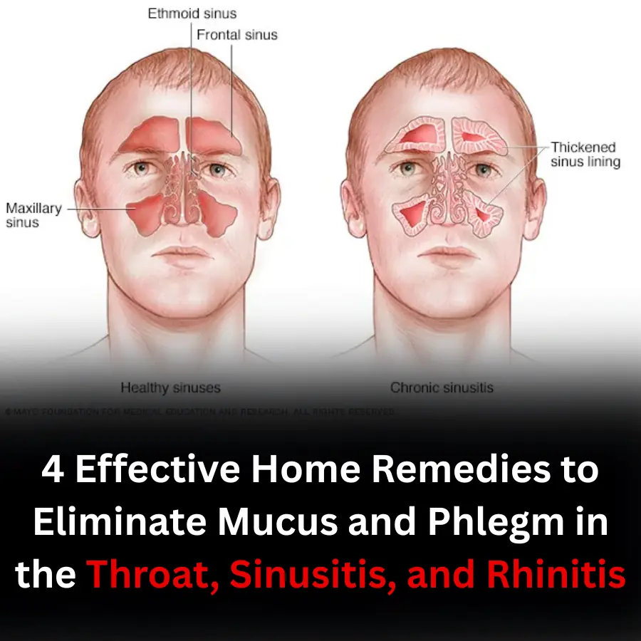 4 Effective Home Remedies to Eliminate Mucus and Phlegm in the Throat, Sinusitis, and Rhinitis