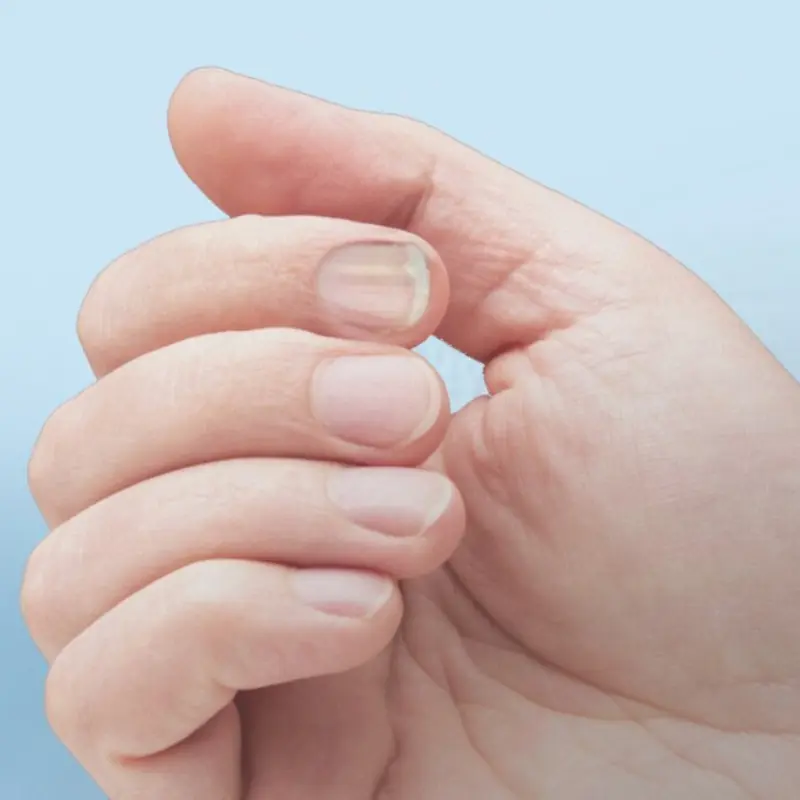 Experts Claim Little-Known Change to Your Fingertips Could Be an Early Indication of Cancer