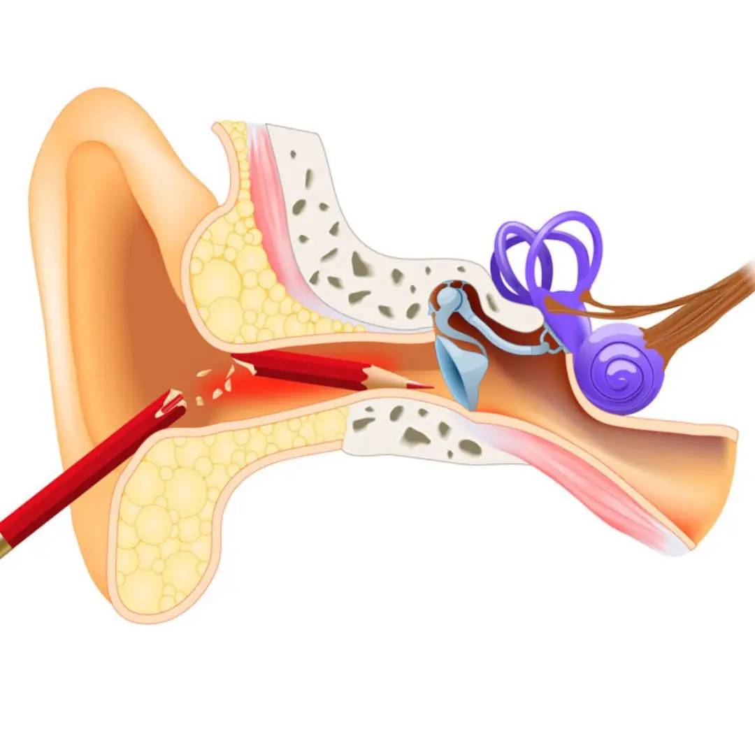 Foreign object stuck in ear? 5 safe steps you need to know right away