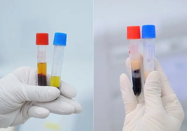 Examination shows milky serum, a warning sign of stroke risk